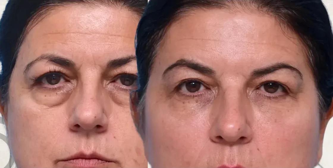 Fillers Ojeras